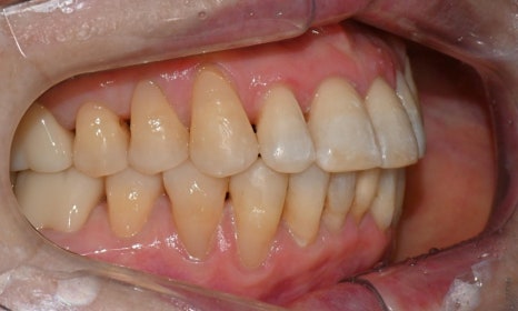 대치동 치경부 레진 & 중년교정 & 치아미백으로 자연스러운 미소를! 관련 이미지 15