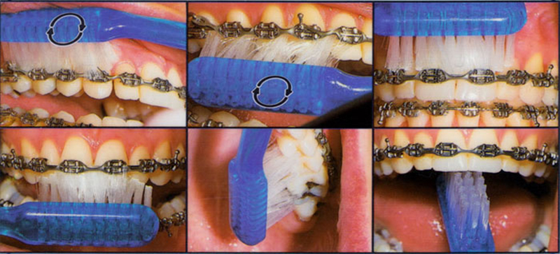 치아교정시 양치법 및 구강위생관리 방법 관련 이미지 3