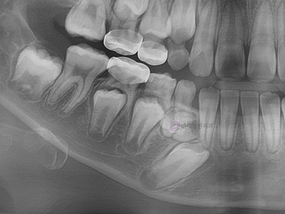 어린이 치아교정 해야 될까요? 대치동 교정치과 관련 이미지 4