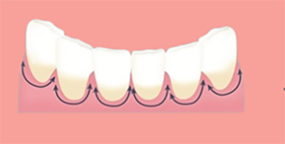 치아교정시 양치법 및 구강위생관리 방법 관련 이미지 8