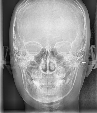 대치동교정치과에서 정밀진단은 어떤 건가요? 연세정원치과 관련 이미지 6