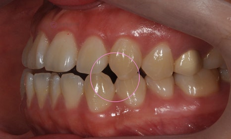 치아 중심선 비대칭 및 개방교합 교정, 대치동 연세정원치과 관련 이미지 3