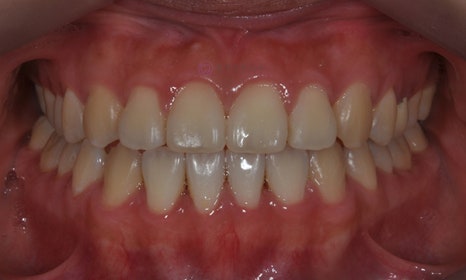 치아 중심선 비대칭 및 개방교합 교정, 대치동 연세정원치과 관련 이미지 13