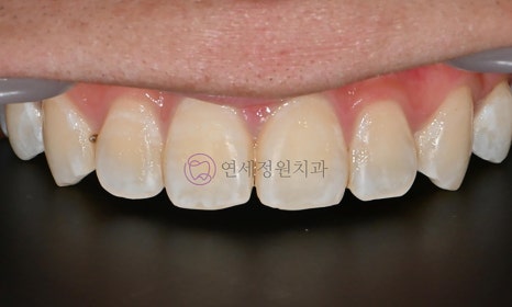 치아 미백 후 반점치의 아이콘 레진 치료 @ 대치동 연세정원치과 관련 이미지 6