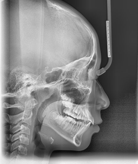 어린이 무턱 액티베이터 성장교정 후 인비절라인 퍼스트 관련 이미지 9