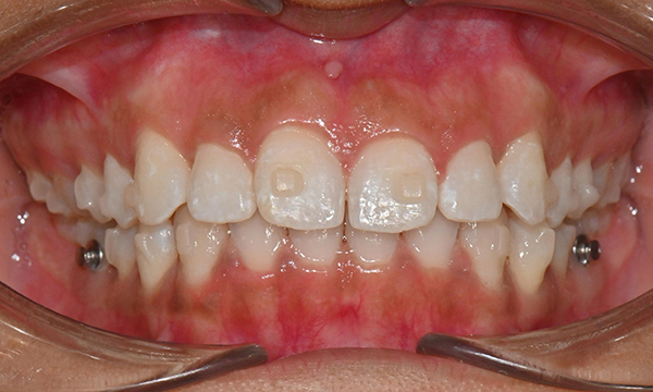개포동 앞니 사이 공간 및 덧니 교정을 원한다면 관련 이미지 7