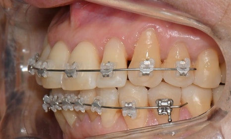 대치동 치경부 레진 & 중년교정 & 치아미백으로 자연스러운 미소를! 관련 이미지 13