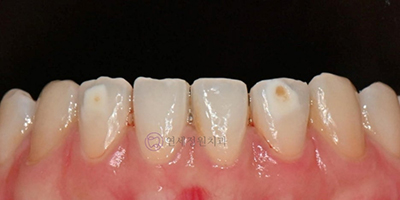 ICON Resin Treatment: White Spots on Front Teeth - Are They Cavities? 관련 이미지 4