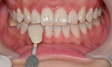 Precautions for Teeth Whitening Treatment @ Yonsei JW Dental Clinic 관련 이미지 11