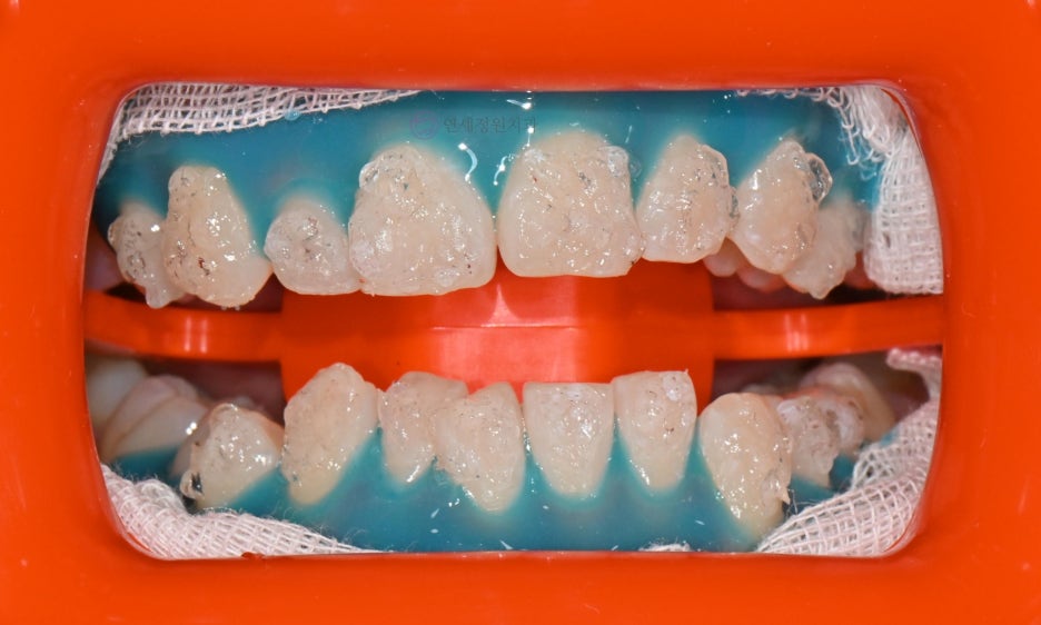 One Day Teeth Whitening Process @ Yonsei JW Dental Clinic 관련 이미지 13