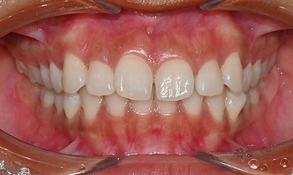 인비절라인 앞니 사이 공간 및 덧니 교정 관련 이미지 2