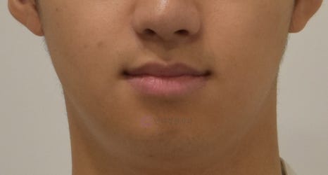 비대칭 및 돌출입 치아교정, 대치동 교정치과 연세정원치과 관련 이미지 8