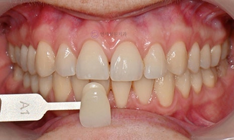 Teeth Whitening Case : A couple from the Netherlands 관련 이미지 8