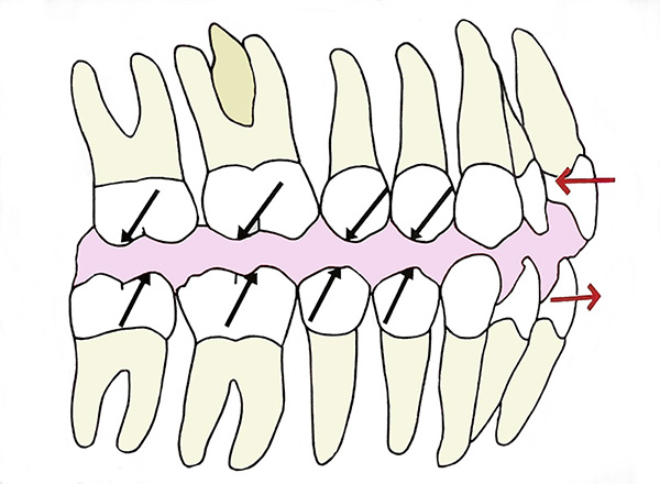 대치동교정치과, 무턱 성장교정과 엑티베이터 관련 이미지 8