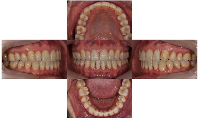 중년의 치아교정 시 고려할 사항, 대치동 연세정원치과 관련 이미지 7