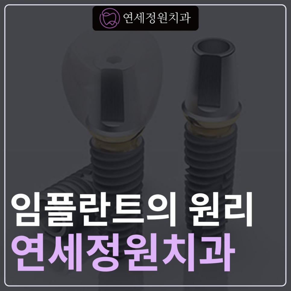 임플란트 원리와 치료과정 @ 학여울역 치과 연세정원치과 관련 이미지 1