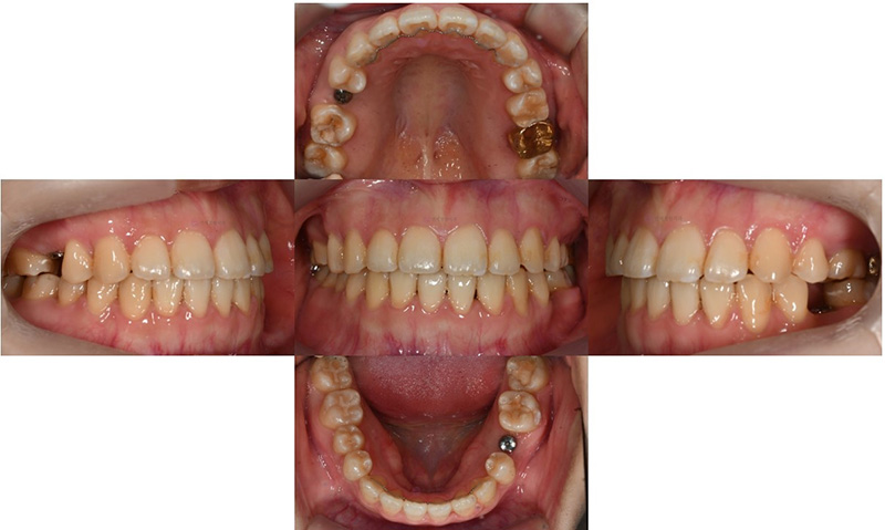 어금니가 겹쳐서 났어요! 이소맹출 소구치 치아교정, 대치동 교정치과 관련 이미지 7