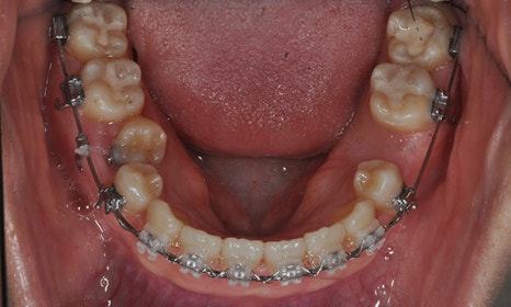 어금니가 겹쳐서 났어요! 이소맹출 소구치 치아교정, 대치동 교정치과 관련 이미지 6