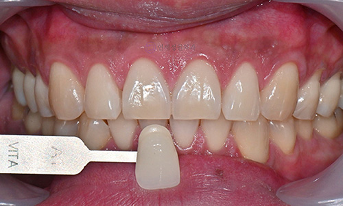 Teeth Whitening Case : A couple from the Netherlands 관련 이미지 6