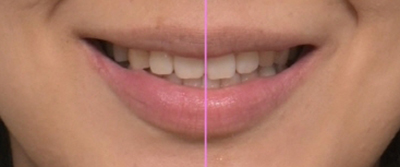 앞니 벌어짐 부분교정 (재교정) 관련 이미지 10