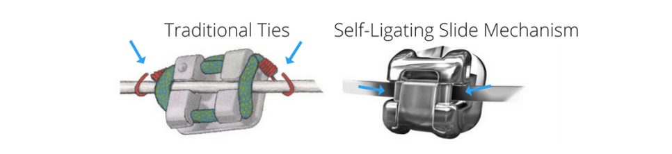 3M 클라리티 울트라 (자가결찰장치) 치아교정 관련 이미지 3