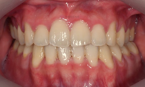 비대칭 및 돌출입 치아교정, 대치동 교정치과 연세정원치과 관련 이미지 19