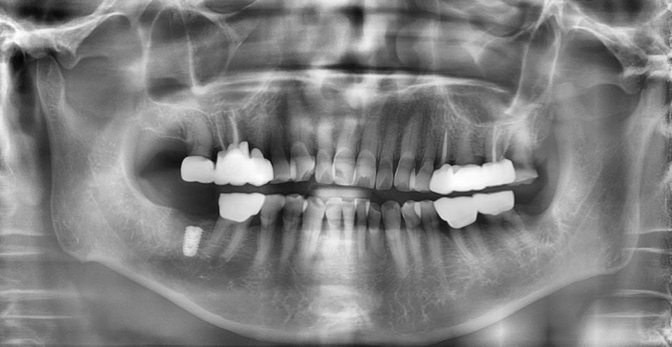 임플란트와 고혈압, 당뇨, 골다공증 등의 전신질환 관련 이미지 3