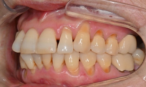 대치동 치경부 레진 & 중년교정 & 치아미백으로 자연스러운 미소를! 관련 이미지 4