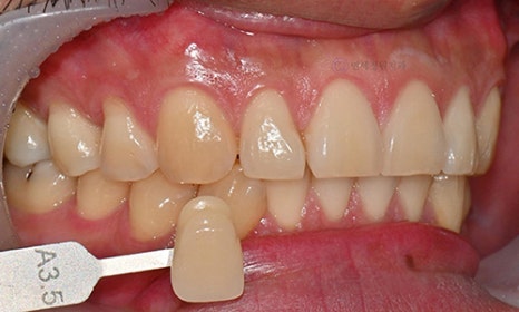Teeth Whitening Case : A couple from the Netherlands 관련 이미지 3