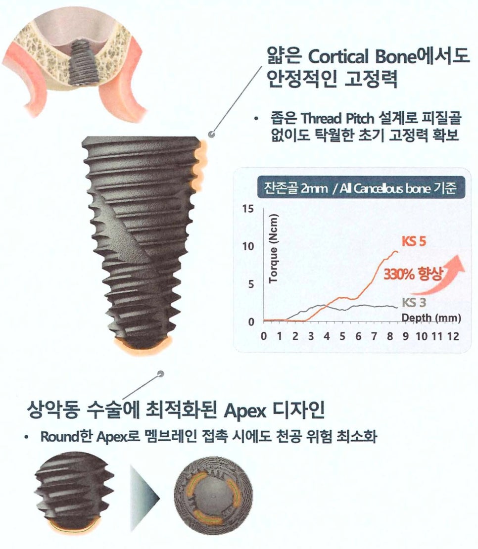 새롭게 출시된 오스템 임플란트 KS 시스템, 무엇이 달라졌을까요? 관련 이미지 3