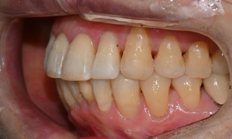 대치동 치경부 레진 & 중년교정 & 치아미백으로 자연스러운 미소를! 관련 이미지 16