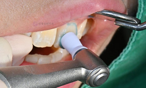 White Spot on My Front Tooth: Cavity or White Spot Lesion? 관련 이미지 5