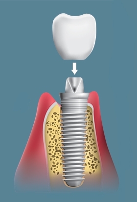 임플란트 1차 수술 vs 2차 수술 관련 이미지 8
