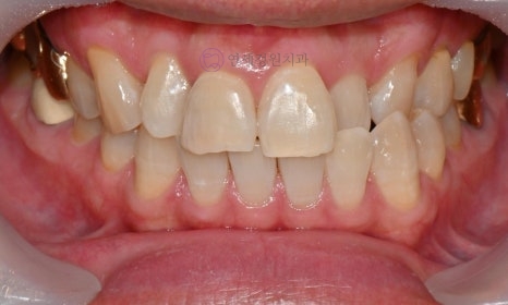 Precautions for Teeth Whitening Treatment @ Yonsei JW Dental Clinic 관련 이미지 7