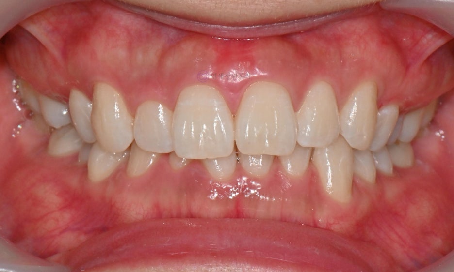 One Day Teeth Whitening Process @ Yonsei JW Dental Clinic 관련 이미지 20