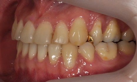 비대칭 및 돌출입 치아교정, 대치동 교정치과 연세정원치과 관련 이미지 6