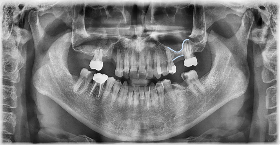 대치동치과 임플란트 수술, 상악동 거상술은 무엇인가요? 관련 이미지 4