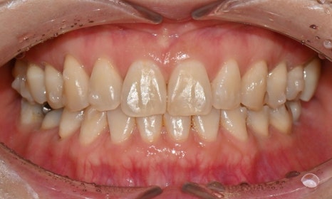 교정 치료 후 치아 미백 관련 이미지 10