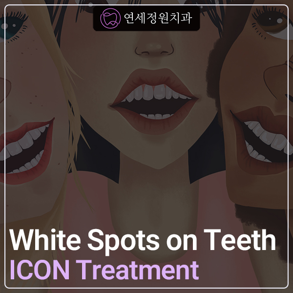 ICON Resin Treatment: White Spots on Front Teeth - Are They Cavities? 관련 이미지 1