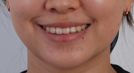 치아 중심선이 안 맞아요! 치아 비대칭 교정으로 가능할까요? @ 대치동 교정치과 연세정원치과 관련 이미지 15