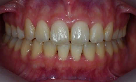 앞니가 안 물려요! 개방교합(openbite) 치아교정 전후 및 후기 관련 이미지 8