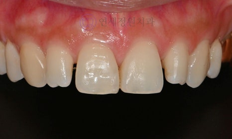 왜소치 치료 - 라미네이트 vs 레진비니어 vs 치아교정 관련 이미지 17