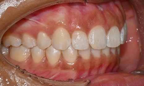 인비절라인 앞니 사이 공간 및 덧니 교정 관련 이미지 13