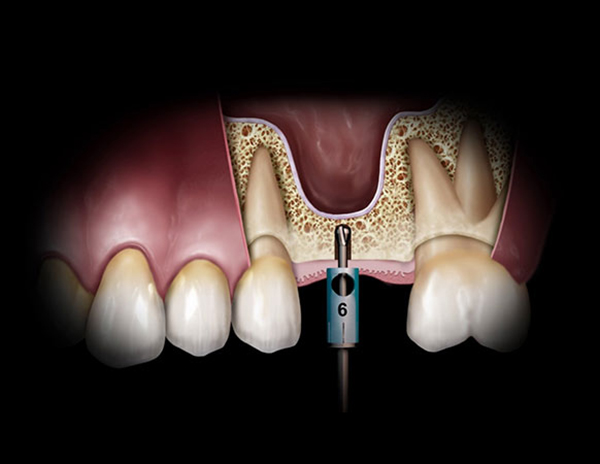 대치동치과 임플란트 수술, 상악동 거상술은 무엇인가요? 관련 이미지 5