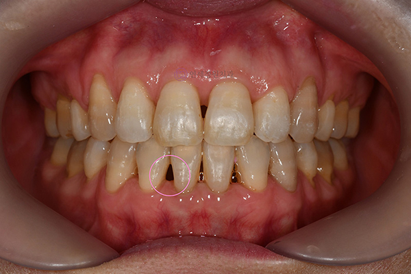 어린이 치아교정 해야 될까요? 대치동 교정치과 관련 이미지 6