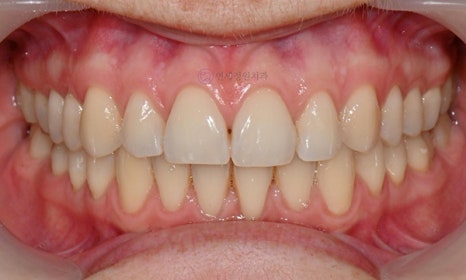 원데이 치아미백 @ 대치동치과 연세정원치과 관련 이미지 7