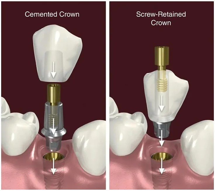 임플란트 평생 쓸 수 있나요? @  대치동치과 연세정원치과 관련 이미지 2