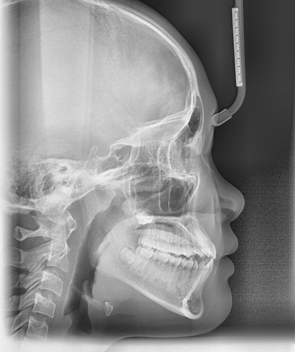 어린이 주걱턱, 페이스 마스크 성장교정 후 인비절라인 관련 이미지 6