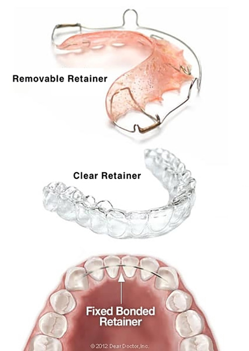 치아교정 이후 유지장치는 언제까지 하나요? 관련 이미지 3