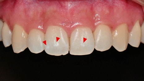 교정치료 후 생긴 치아 하얀 점, 반점치도 아이콘 치료로! @ 대치동 교정치과 연세정원치과의원 관련 이미지 6